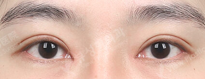 Double Eyelid (Incisional)+ Epicanthoplasty (3 Months) — After