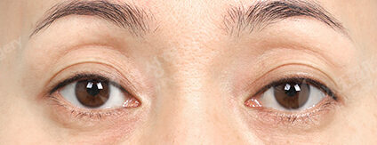 Lower Blepharoplasty+Transconjuntival fat removal (3 Months) — Before