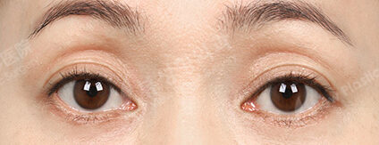 Lower Blepharoplasty+Transconjuntival fat removal (3 Months) — After