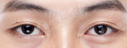 Ptosis (Incisional)(3 Months) — Before