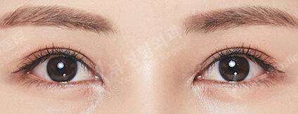 Ptosis (Incisional)(3 Months) — After