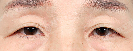 Crease Double Eyelid+Lower Blepharoplasty+Ptosis (3 Months) — Before