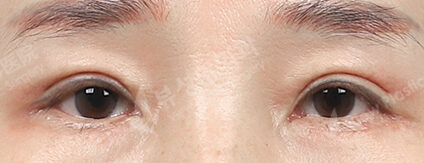 Crease Double Eyelid+Lower Blepharoplasty+Ptosis (3 Months) — After