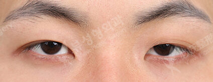 Fat Graft+Ptosis+Epicanthoplasty (3 Months) — Before