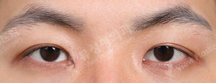 Fat Graft+Ptosis+Epicanthoplasty (3 Months) — After