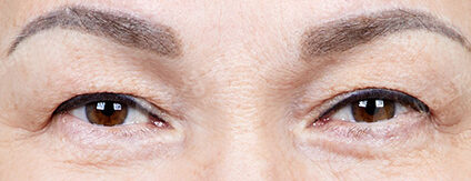 Lower Blepharoplasty (Revisional Surgery)+ Upper Blepharoplasty (3 Months) — Before