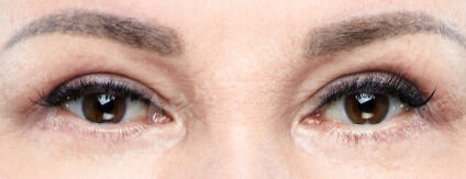 Lower Blepharoplasty (Revisional Surgery)+ Upper Blepharoplasty (3 Months) — After