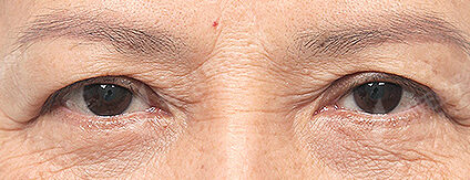 Upper Blepharoplasty+Lower Blepharoplasty (Revisional Surgery)(3 Months) — Before