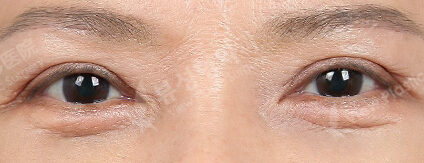 Upper Blepharoplasty+Lower Blepharoplasty (Revisional Surgery)(3 Months) — After