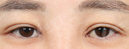 Incisional Ptosis Correction (6 Months) — Before