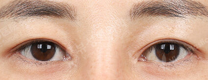 Incisional Ptosis Correction (6 Months) — After