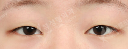 Combination Ptosis Correction Surgery (3 Months) — Before