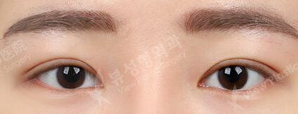 Combination Ptosis Correction Surgery (3 Months) — After