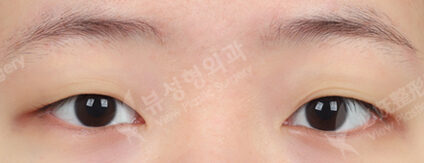 Combination Ptosis Correction Surgery (3 Months) — Before