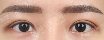 Combination Ptosis Correction Surgery (3 Months) — After