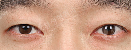 Transconjuntival fat removal+Double Eyelid (Burial)(3 Months) — Before