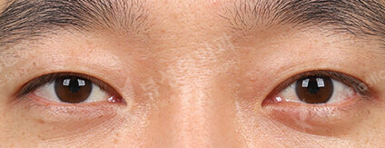 Transconjuntival fat removal+Double Eyelid (Burial)(3 Months) — After