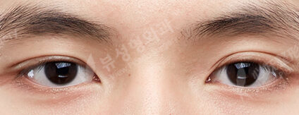 3 Types Face Contouring (Cheekbone+Angular Jaw+Chin Tip)+ Double Eyelid (Incisional)+ Fat Graft (Forehead , Frontal Cheeks)(9 Months) — Before
