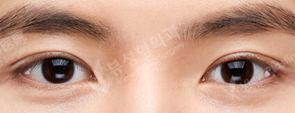 3 Types Face Contouring (Cheekbone+Angular Jaw+Chin Tip)+ Double Eyelid (Incisional)+ Fat Graft (Forehead , Frontal Cheeks)(9 Months) — After