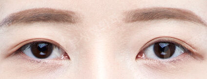 Combination Ptosis Correction Surgery+Lateral CanthoplastyLower Canthoplasty+3 Types Face Contouring (9 Months) — Before