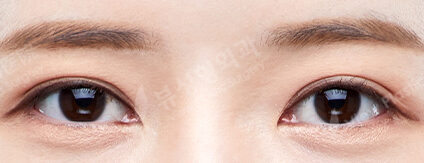 Combination Ptosis Correction Surgery+Lateral CanthoplastyLower Canthoplasty+3 Types Face Contouring (9 Months) — After