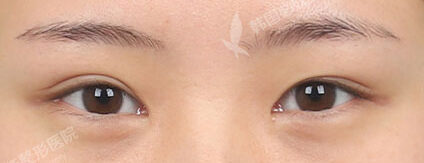 Double EyelidRevisional Surgery ,Lateral Canthoplasty ,Lower Canthoplasty (6 Months) — Before