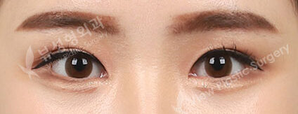 Double EyelidRevisional Surgery ,Lateral Canthoplasty ,Lower Canthoplasty (6 Months) — After
