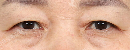 Upper Blepharoplasty+Lower Blepharoplasty (3 Months) — Before