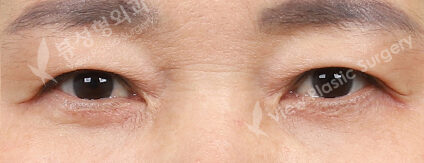 Upper Blepharoplasty+Lower Blepharoplasty (3 Months) — After