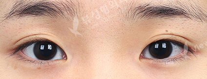 Incisional Ptosis (3 Months) — Before