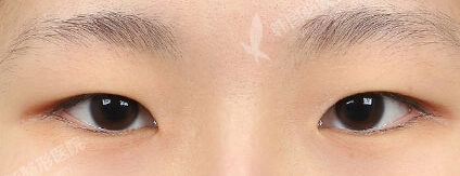 Combination Ptosis Correction Surgery+Epicanthoplasty+Lateral Canthoplasty (3 Months) — Before