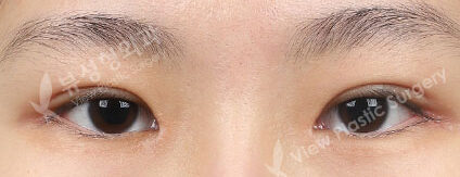 Combination Ptosis Correction Surgery+Epicanthoplasty+Lateral Canthoplasty (3 Months) — After