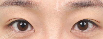 Combination Ptosis Correction Surgery (3 Months) — Before