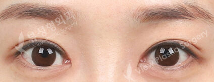 Combination Ptosis Correction Surgery (3 Months) — After