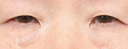 Upper Blepharoplasty+Lower Blepharoplasty (3 Months) — Before