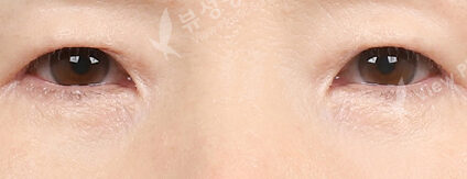 Upper Blepharoplasty+Lower Blepharoplasty (3 Months) — After