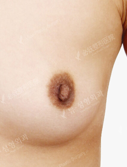 Nipple Reduction (5 Months) — Before