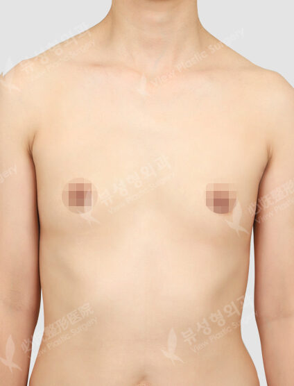 Breast Augmentation Surgery (6 Months) — Before
