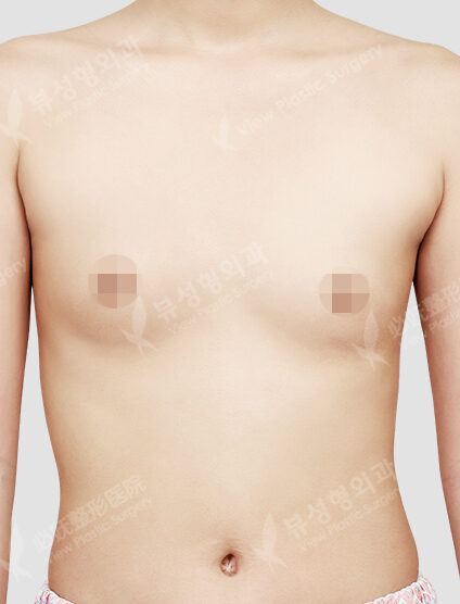 Breast Augmentation Surgery (6 Months) — Before