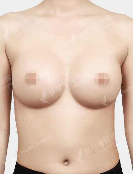 Breast Augmentation Surgery (6 Months) — After