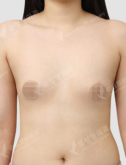 Breast Augmentation (Tear Drop)(5 Months) — Before