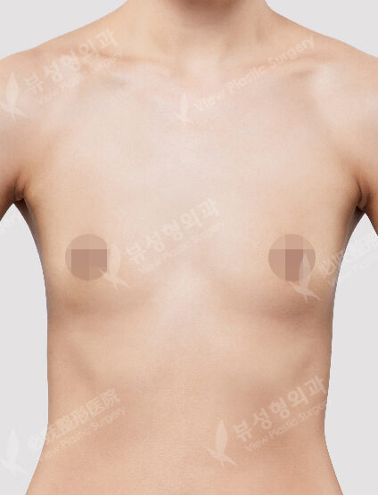Breast Augmentation (Motiva)(6 Months) — Before