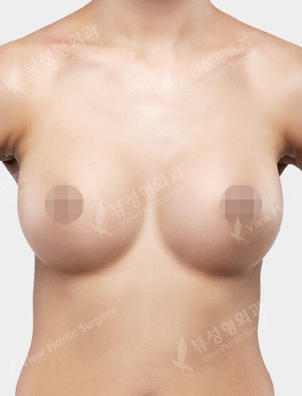 Breast Augmentation (Motiva)(6 Months) — After