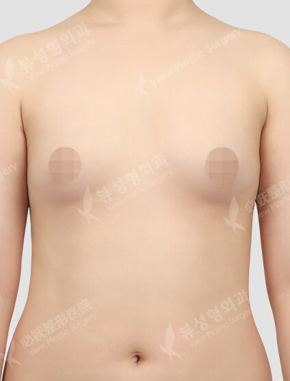 Breast Augmentation Surgery (Bellagel)+ Accessory Breast (6 Months) — Before