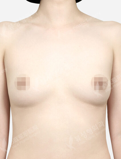 Breast Augmentation (Bellagel) 3 Months — Before