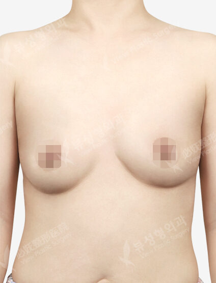 Breast Augmentation (Bellagel) 3 Months — Before