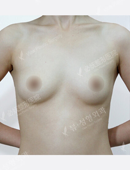 Breast Augmentation (1 Year) — Before