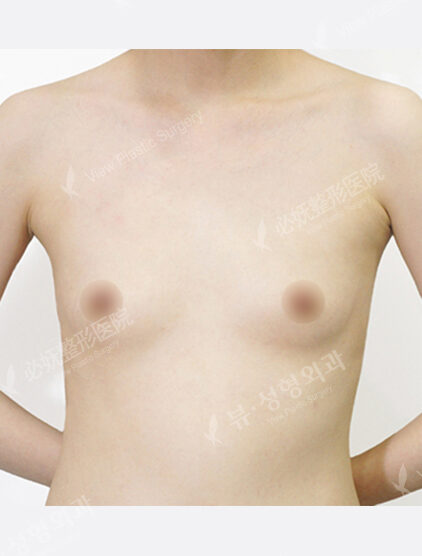 Breast Augmentation (4 Months) — Before