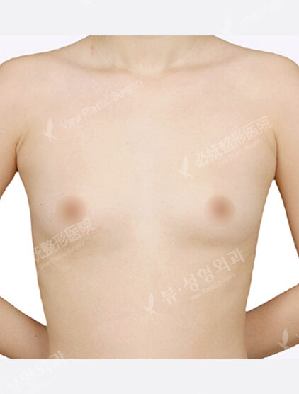 Breast Augmentation (1 Months) — Before