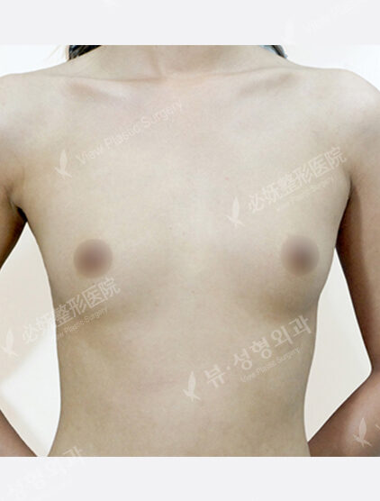 Breast Augmentation ( 10 Months) — Before